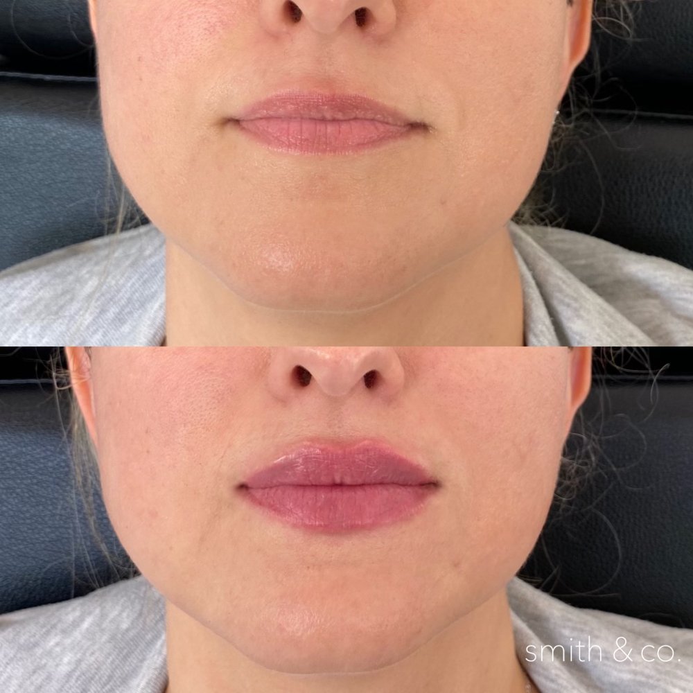 smith & co botox specialist